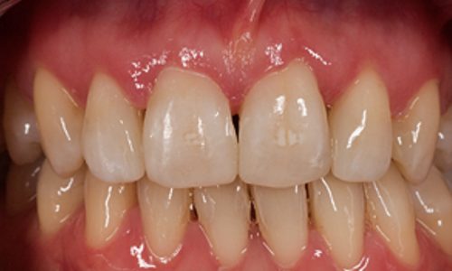Die Zähne wurden adhäsiv mit Compositematerial angepasst